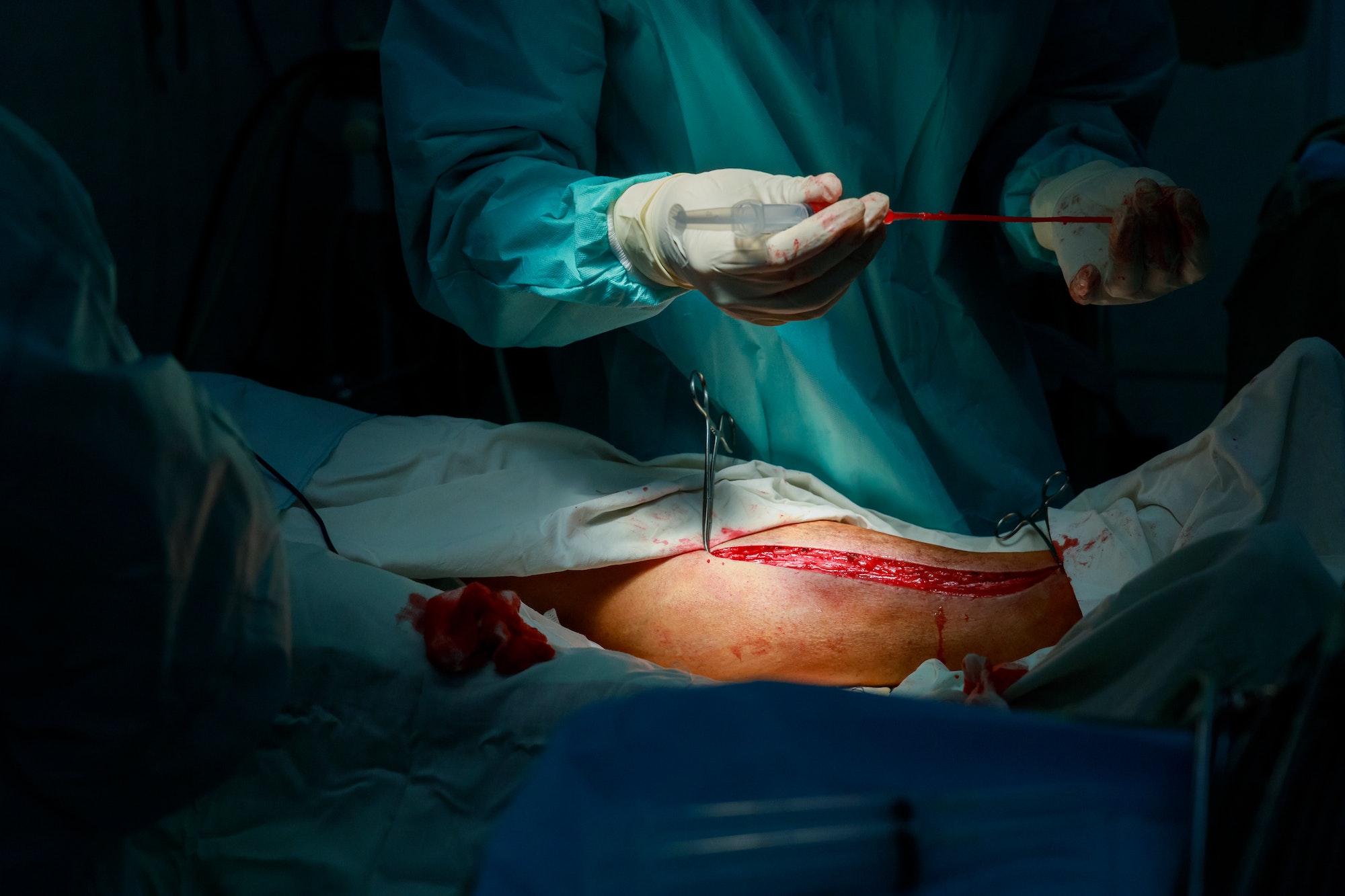 A surgeon pick out a vein leg to heart bypass surgery operation in the operating room