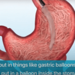 Simplifying Bariatric Surgery