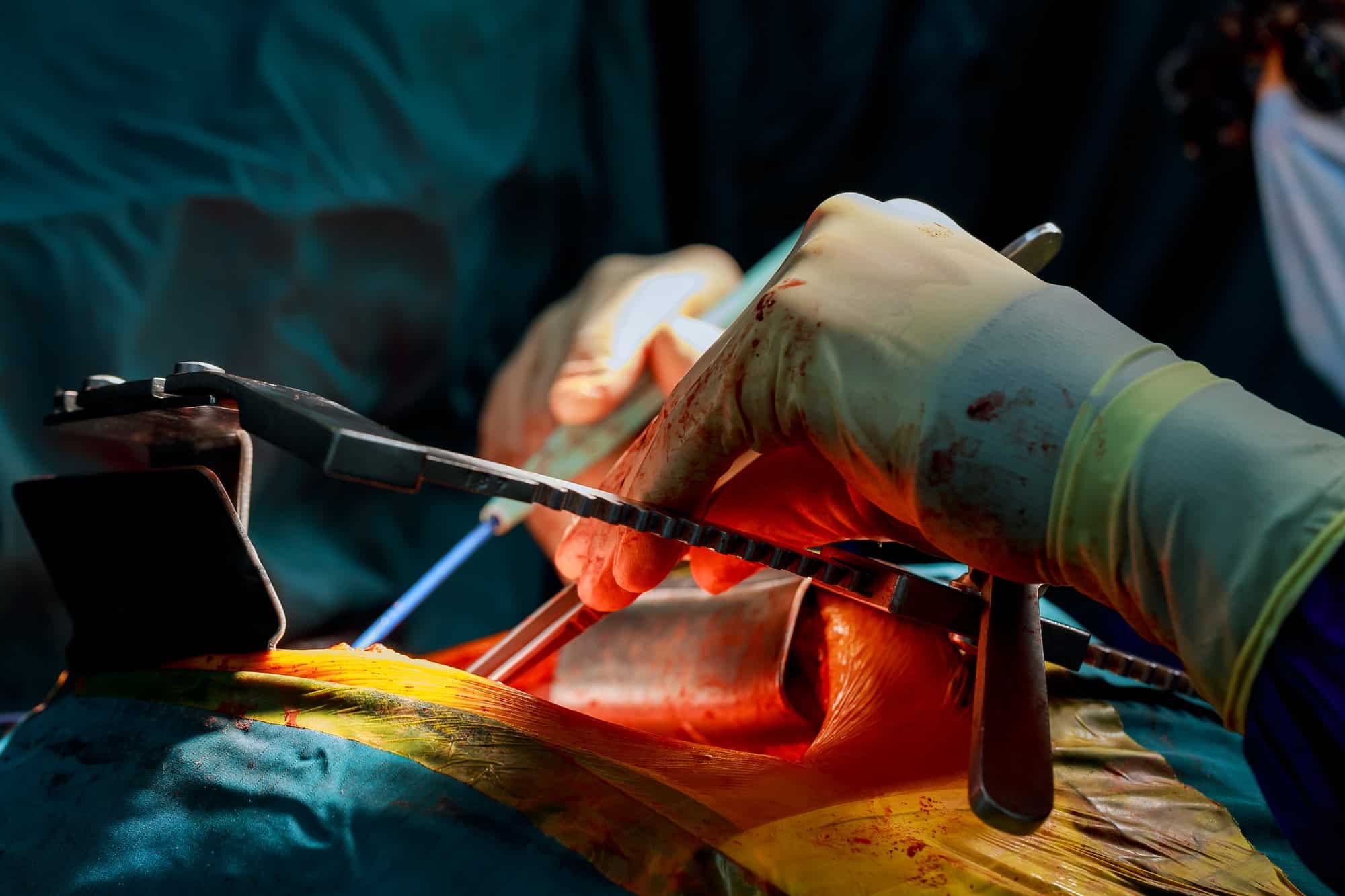 The process of cardiac surgery open heart surgery for coronary surgery